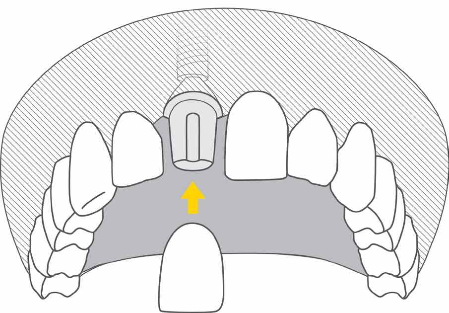 implant z koroną - ilustracja