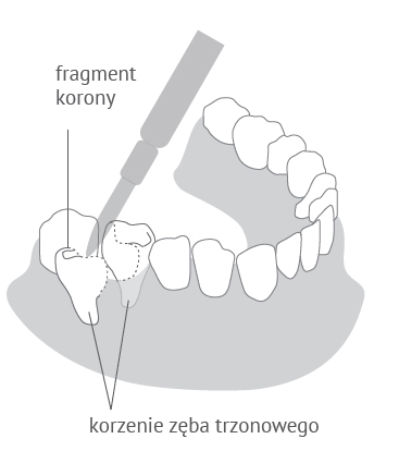 Hemisekcja zęba trzonowego w Dentim Clinic