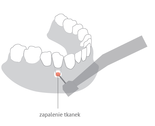 Resekcja korzenia zęba w Dentim Clinic