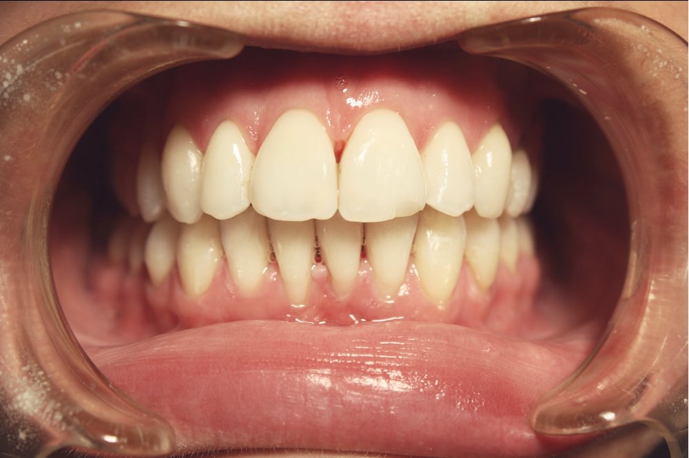 aparat ortodontyczny 6a dentim clinic katowice