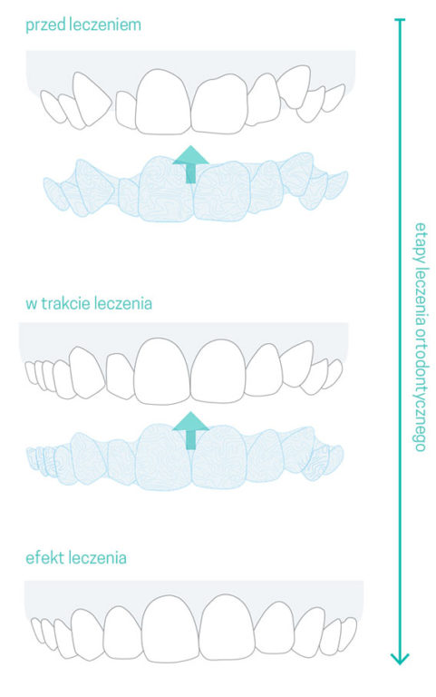 Na czym polega metoda leczenia zębów metodą przeźroczyste nakładki ortodontyczne